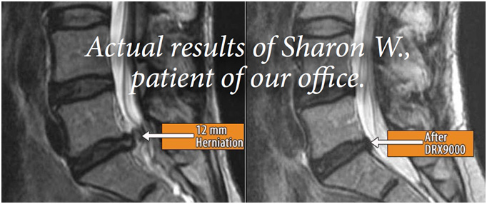 MRI Images Before and After Non-Surgical Spinal Decompression at Irvine Spine and Sport. Lumbar Disc Herniation with Extrusion