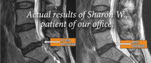 DRX9000-MRI-After-Spinal-Decompression-Therapy-at-Irvine-Spine-and-Sport-an-Orange-County-CA-Chiropractic-and-Spinal-Decompression-Clinic